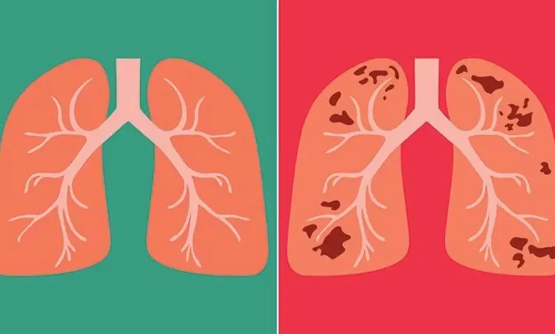 The increasing number of TB patients has raised concerns, efforts to prevent it have intensified in Uttarakhand